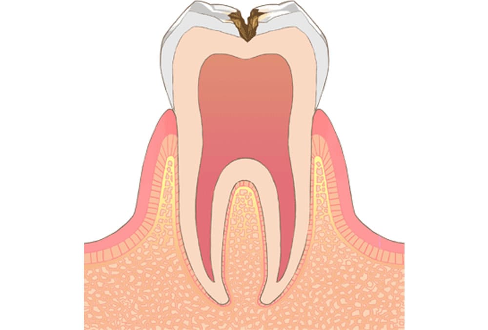 C2【象牙質の虫歯】