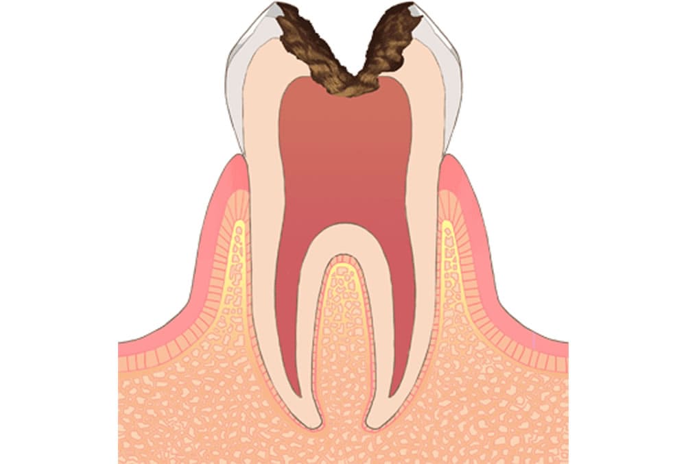 虫歯が神経にまで進行した状態