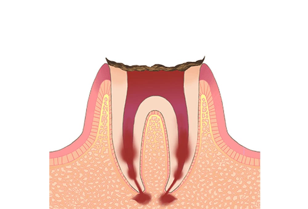 C4【歯の根だけが残っている状態】