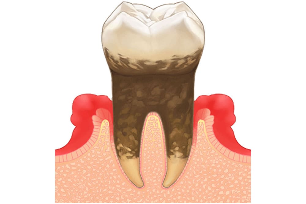 歯周病とは
